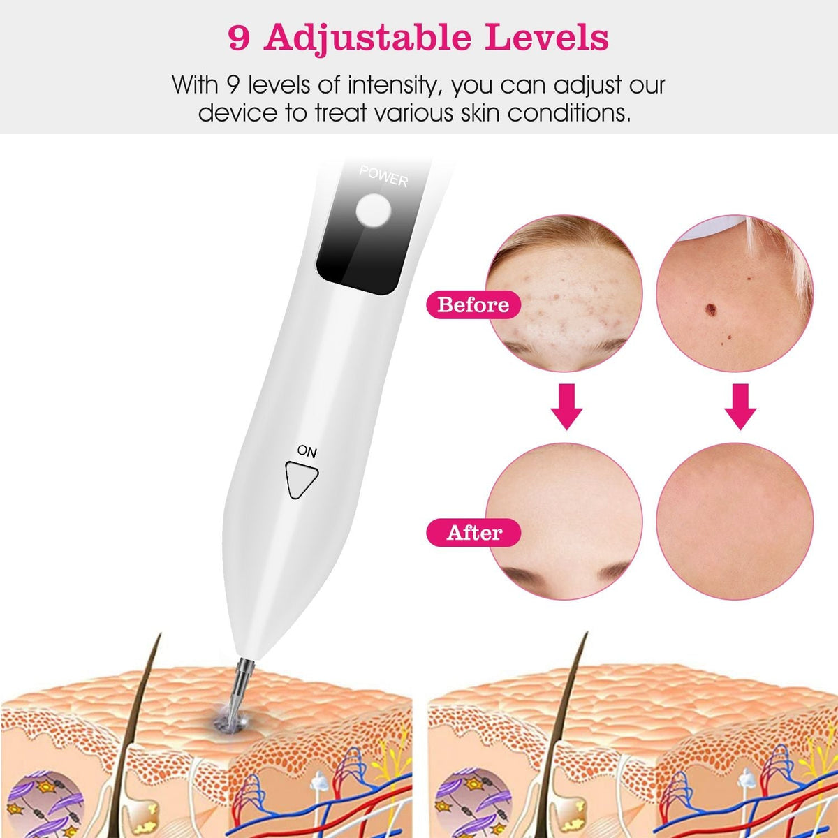 Skin Tag Removal Kit - Portable Multi-Level Beauty Tool with Adjustable LCD & USB Charging, 6 Replacement Needle Options for Home Use - MC Online